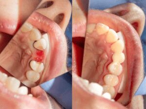 Do Dental Bridges Hurt?