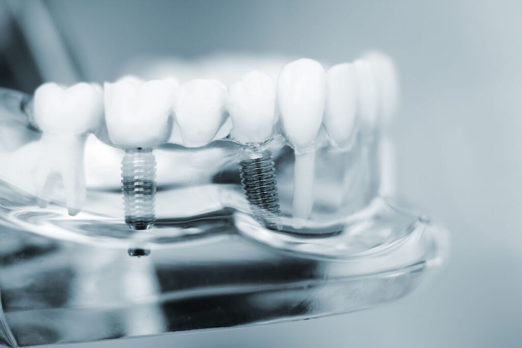 DENTAL IMPLANTS in ARDMORE PA aren't for everyone, but they can help if you're eligible