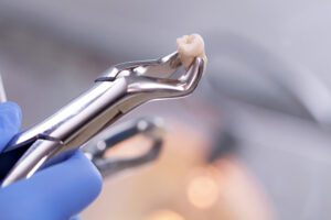 After a Tooth Extraction in Ardmore, PA, you need to care for the socket