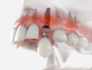 Missing teeth can compromise the structural integrity of your entire mouth, leading to complications without treatment.