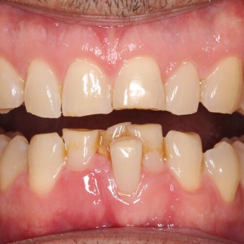 Before dental care at The Office of Dr. Bellisario