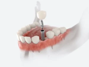 Bridges vs. Implants: Which to Choose in Ardmore, PA